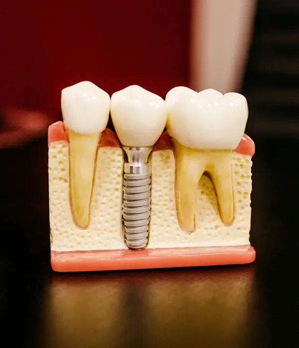 real dental implant model sitting on a desk